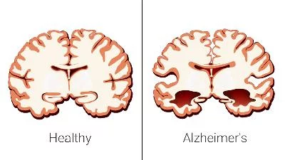 Ini 5 Aktivitas yang Dapat Mencegah Risiko Alzheimer
