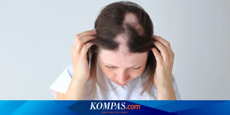 Apa Penyebab Alopecia Areata? Halaman all