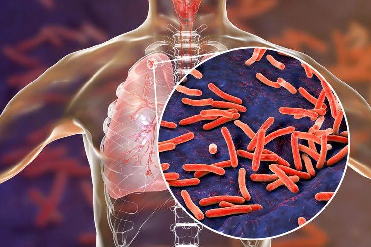 5 Gejala TBC yang Perlu Anda Ketahui, Dari Bakteri Jadi Penyakit