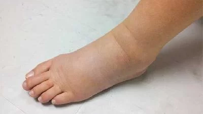 Gejala Kolesterol Tinggi yang Terlihat dari Kaki