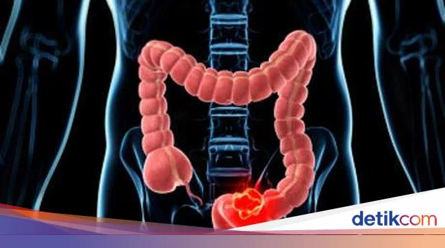 Radang Usus Buntu: Gejala, Komplikasi, dan Pengobatannya