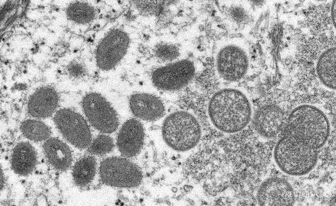 2 Jenis Virus Monkeypox Terdeteksi di AS, Ini Cici-Ciri Gejala Cacar Monyet