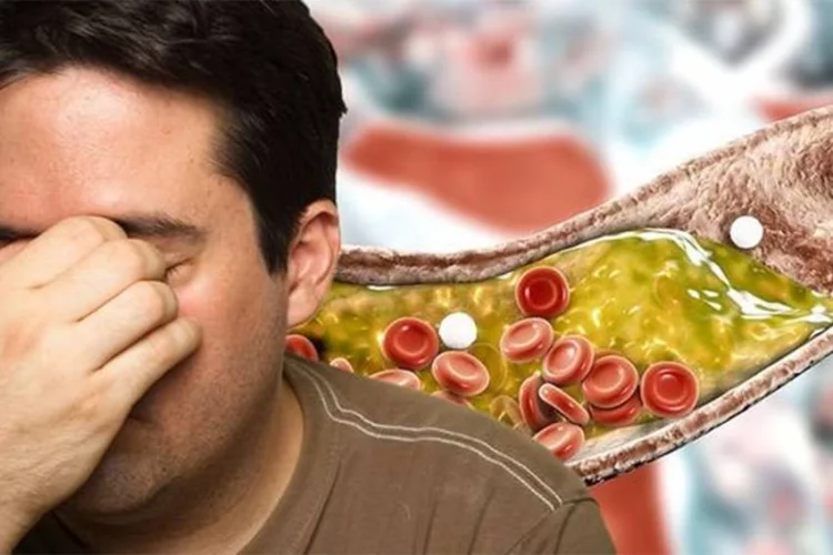4 Penyakit yang Disebabkan Kolesterol Tinggi, Waspada!