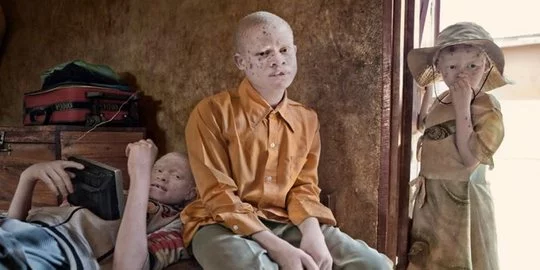 Peringatan Hari Kesadaran Albinisme Internasional, Hindari Diskriminasi