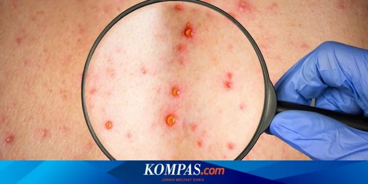 Virus Cacar Monyet Ditemukan di Cairan Sperma Pasien, WHO Selidiki Laporan Ini