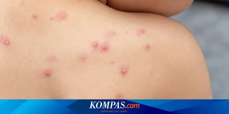 Remaja Suspek Monkeypox di Kalbar Membaik dan Dipastikan Mengidap Cacar Air