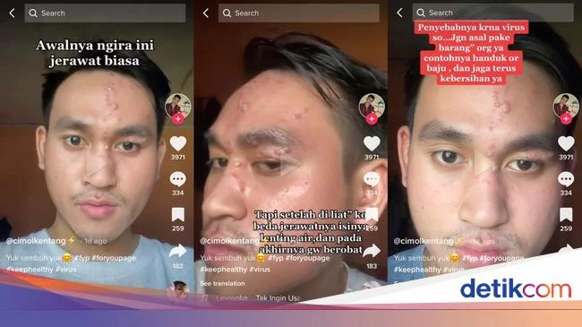 Fakta-fakta Pria Jakarta Kena Herpes Zoster, Kronologi-Gejala yang Dialami