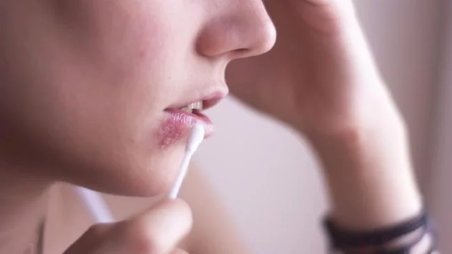 Viral Pria Terkena Herpes Zoster, Simak Bedanya dengan Jerawat