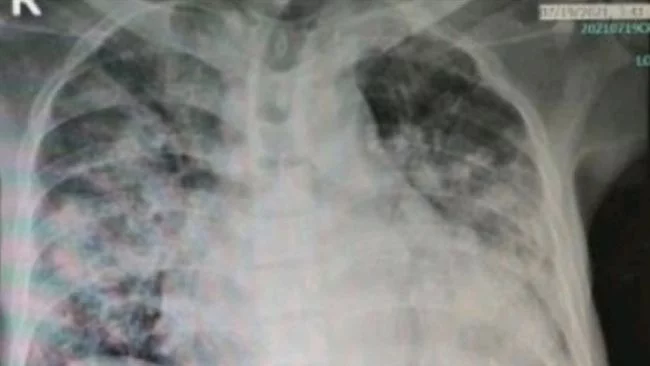 10 Gejala Infeksi Paru-paru Seperti yang Diidap Tjahjo Kumolo