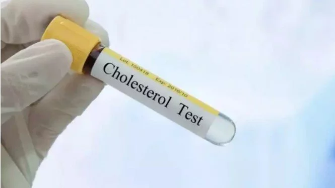 Ketahui Efek Samping Kolesterol Terlalu Tinggi