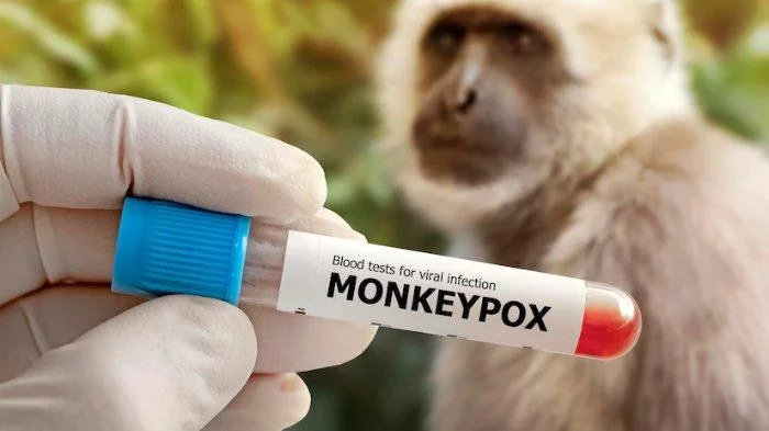 Gejala Monkeypox: Ruam Mirip Cacar Air, Demam, Kelelahan, hingga Sakit Kepala