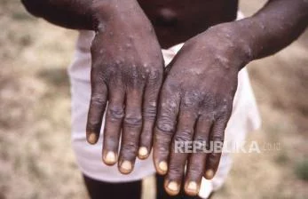 Virus Cacar Monyet Bisa Bertahan di Air Mani Hingga Beberapa Pekan Setelah Sembuh