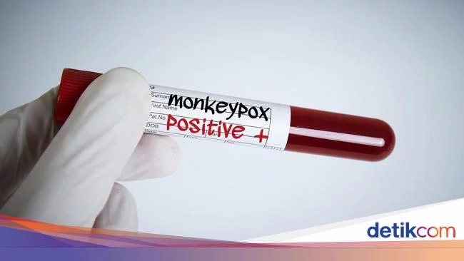 Pasien Pertama Cacar Monyet RI Sudah Sembuh, Begini Kondisi 5 Kontak Erat