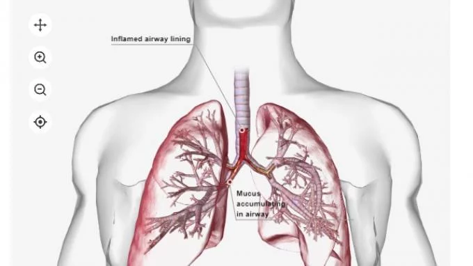 WHO Pantau Langsung Kasus Pneumonia Misterius yang Dikaitkan dengan Legionella di Argentina