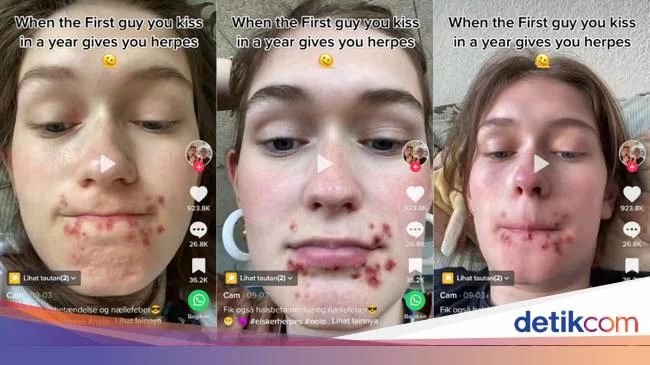 Viral Wanita Kena Herpes Gegara Ciuman, Memang Apa Saja Penularannya?