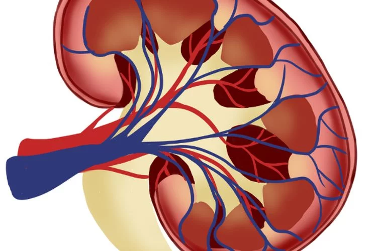 Inilah 6 Kondisi Yang Menyebabkan Ginjal Bocor Terjadi