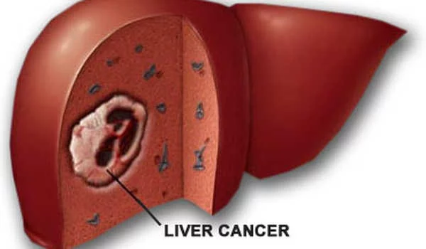 Kematian Akibat Kanker Hati Diprediksi Meningkat 55% pada 2040