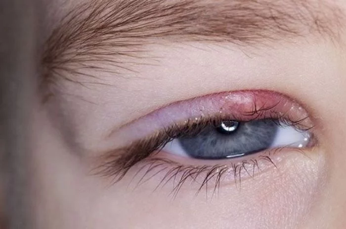 Bintitan di Area Mata, Apakah Termasuk Penyakit Mata yang Serius?