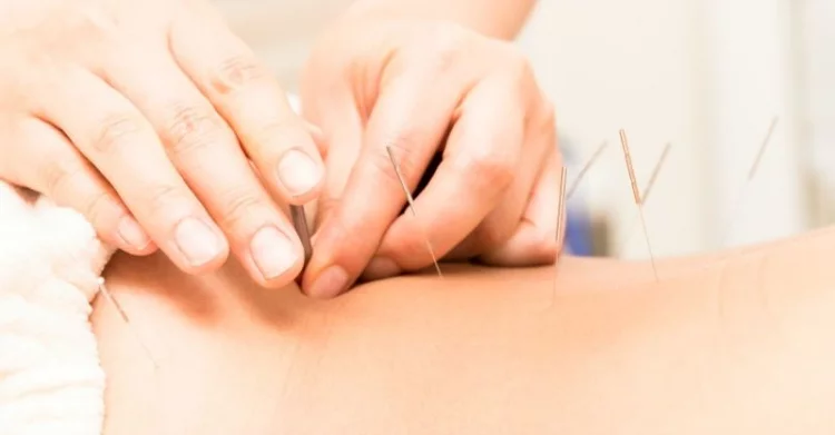 Mengobati Biduran dengan Teknik Akupunktur, Sudah Pernah Coba?