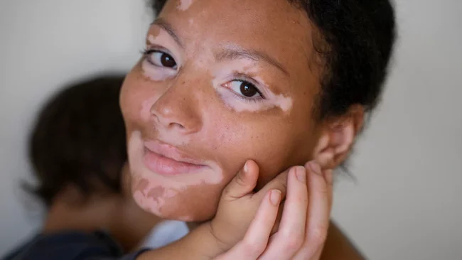 Mengenal Penyakit Vitiligo dan Beragam Perawatannya yang Perlu Beauties Ketahui