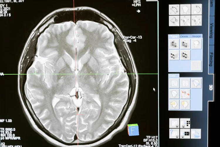 Kenali Apa Itu Kanker Otak: Gejala, Penyebab dan Cara Pengobatannya - Pikiran-Rakyat.com