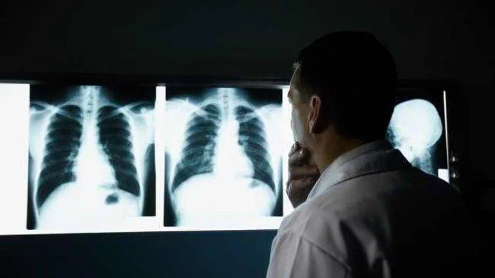 Kenali Gejala Kanker Paru-paru Penyakit Paling Mematikan, Ini Penyebabnya