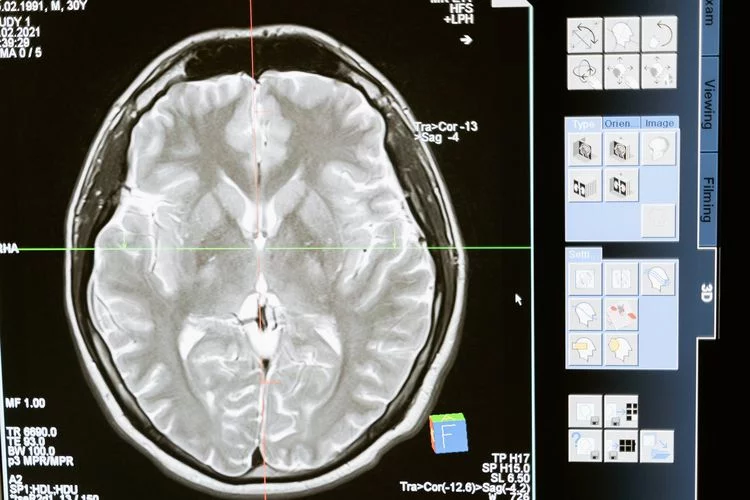 7 Jenis Tumor Otak yang Perlu Diketahui Sesuai dengan Lokasinya