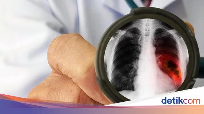 8 Macam Penyakit Paru-paru yang Umum Terjadi dan Gejalanya