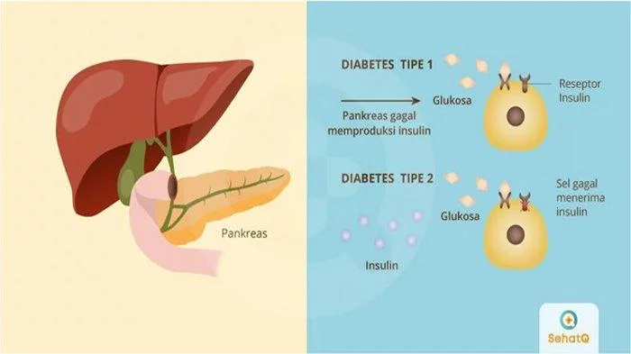 Pahami Fakta-fakta Diabetes lewat Layanan Kesehatan Penyakit Dalam di SehatQ