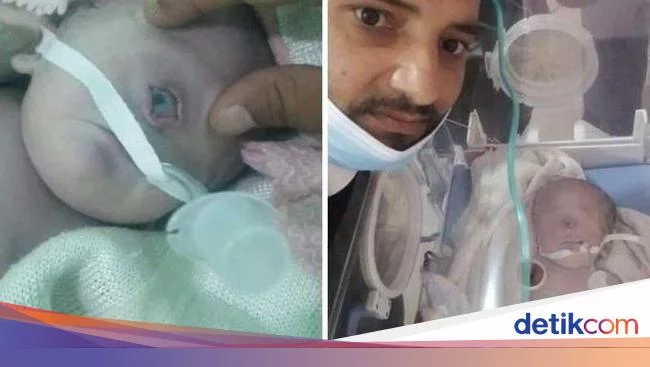 Viral Bayi Bermata Satu Lahir di Yaman, Ini Kemungkinan Penyebabnya