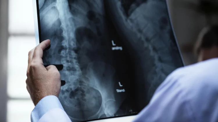 7 Tanda-Tanda Osteoporosis yang Perlu Diwaspadai, Lengkap Cara Mengobatinya