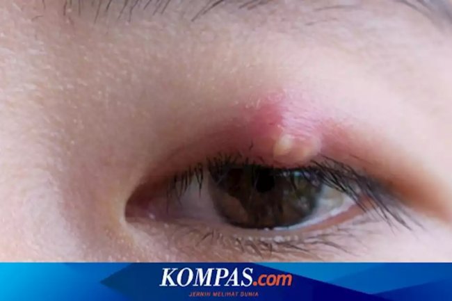 Kenapa Mata Sering Bintitan? Kenali 7 Penyebab dan Cara Mengobatinya