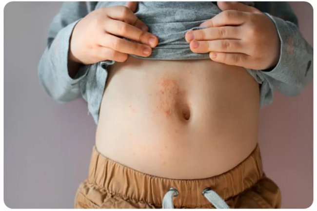 Apa Itu Scabies dan Bagaimana Mengobatinya