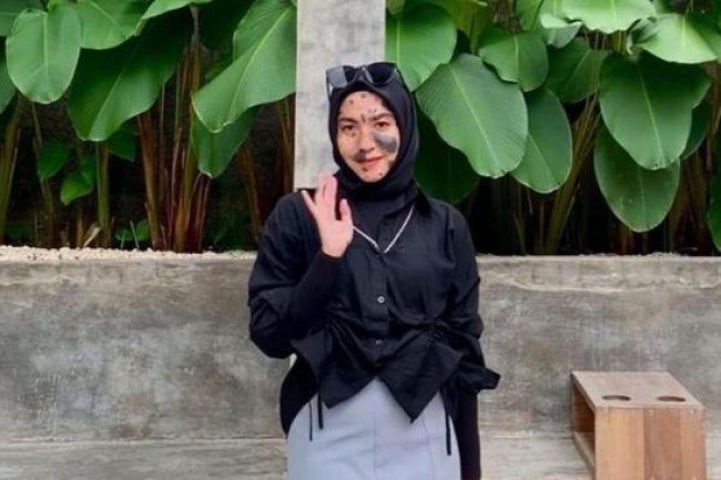 Punya Banyak Tanda Lahir, Wanita Ini Pede & Enggan Operasi karena Pesan Ibunda