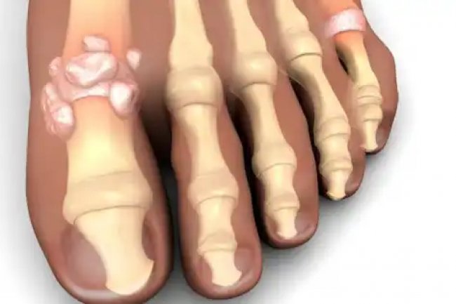 Penyakit asam urat bukan peradangan biasa, mengapa bisa nyeri di sendi