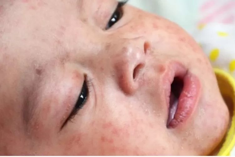 Pentingnya Imunisasi Campak, Kapan Harus Diberikan Pada Anak dan Orang Dewas dan Efek Sampingnya