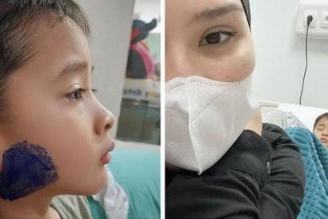 Dialami Anak Zaskia Adya Mecca, Ini 5 Cara Perawatan Gondongan pada Anak