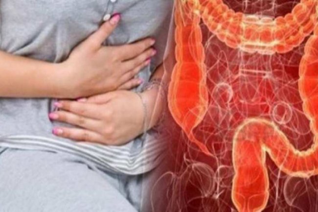 Fakta-fakta Kanker Usus Besar, Sumbang Kematian Tertinggi di Indonesia