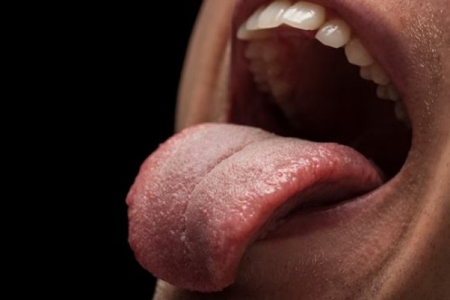 Glositis atau Si Radang Lidah: Mengenal Gejala, Penyebab, dan Penanganannya
