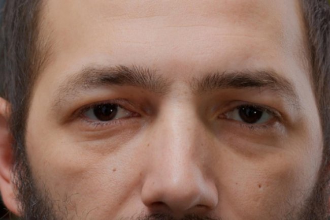 4 Tanda Peringatan Dari Wajah yang Perlu Diketahui tentang Kolesterol tinggi