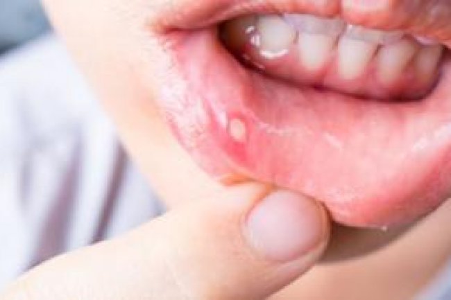 6 Makanan Yang Wajib Dihindari Saat Sariawan Melanda