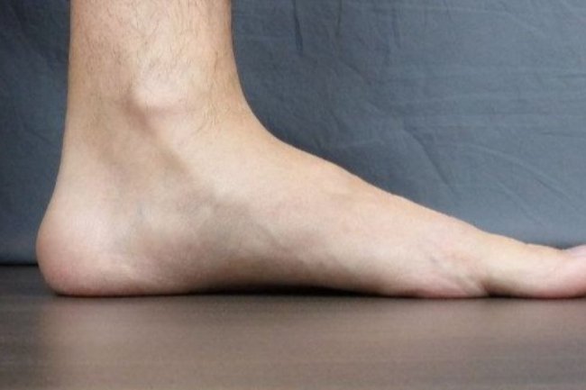 Flat Foot: Penyebab dan Cara Mengobatinya