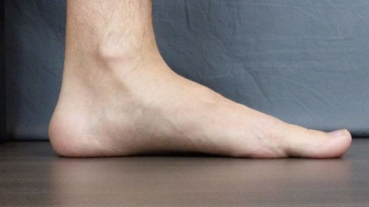 Flat Foot: Penyebab dan Cara Mengobatinya