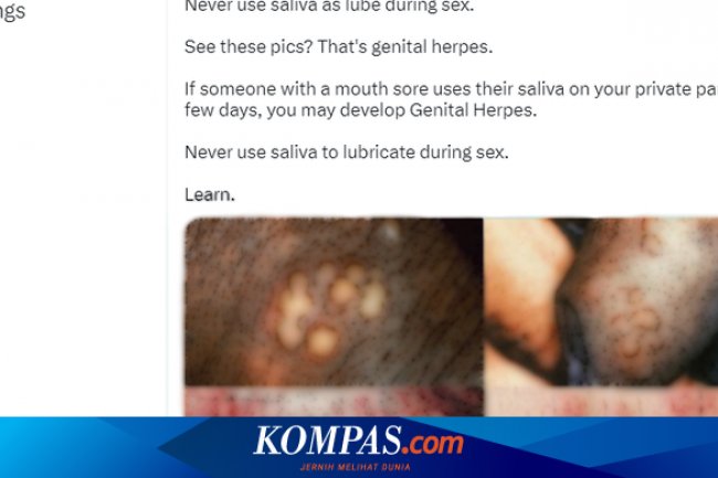 Benarkah Pakai Air Liur Saat Hubungan Seks Bisa Memicu Herpes Genital?