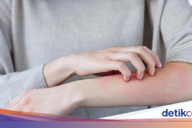 Muncul Ruam Merah yang Terasa Kering di Kulit, Tanda Penyakit Apa Dok?