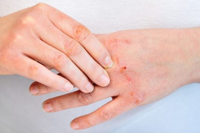 Cara Mencegah dan Obat Herbal untuk Mengatasi Scabies Jika Tertular