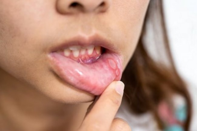 Sariawan Bisa Menjadi Tanda-tanda Kanker Mulut, Ketahui 8 Penyebabnya