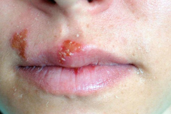 8 Cara Mengobati Herpes di Wajah, Redakan Rasa Sakitnya