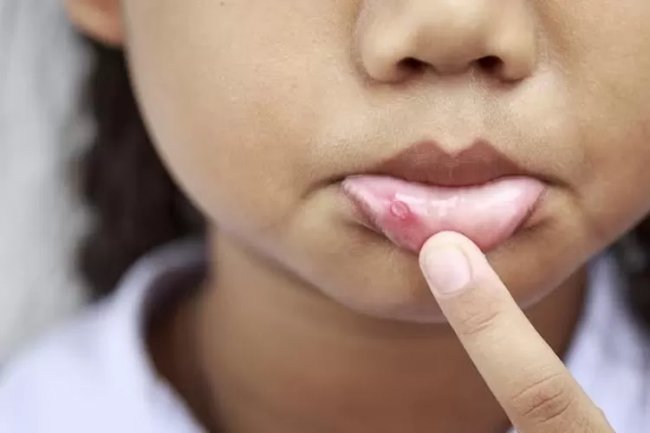 Hempas Rasa Sakit! Simak 5 Solusi Mengatasi Sariawan agar Tidak Mengganggu Saat Makan, Gunakan Bahan Alami