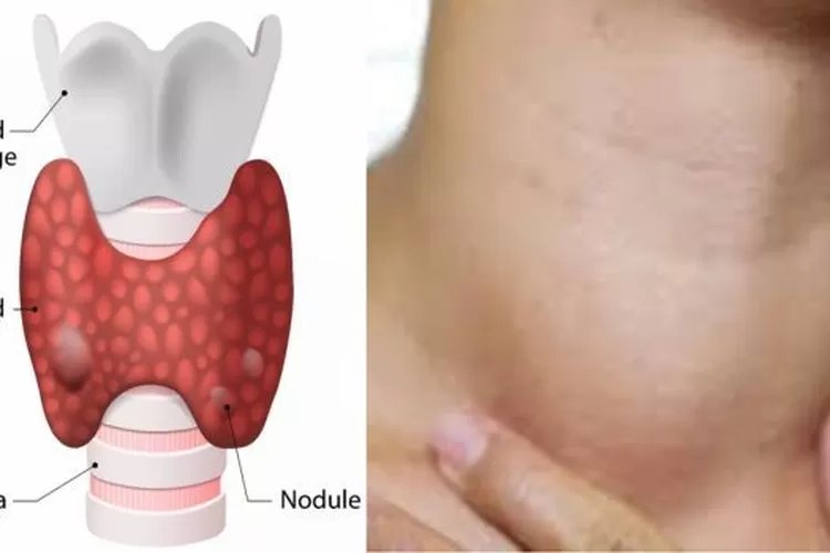 Gangguan kelenjar tiroid, lengkap definisi, gejala hingga cara pengobatannya